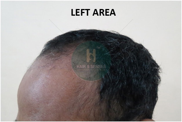 Before Procedure
